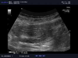 Ultrazvok prebavil - tanko črevo uvihano samo vase (intususcepcija) - vzdolžni presek